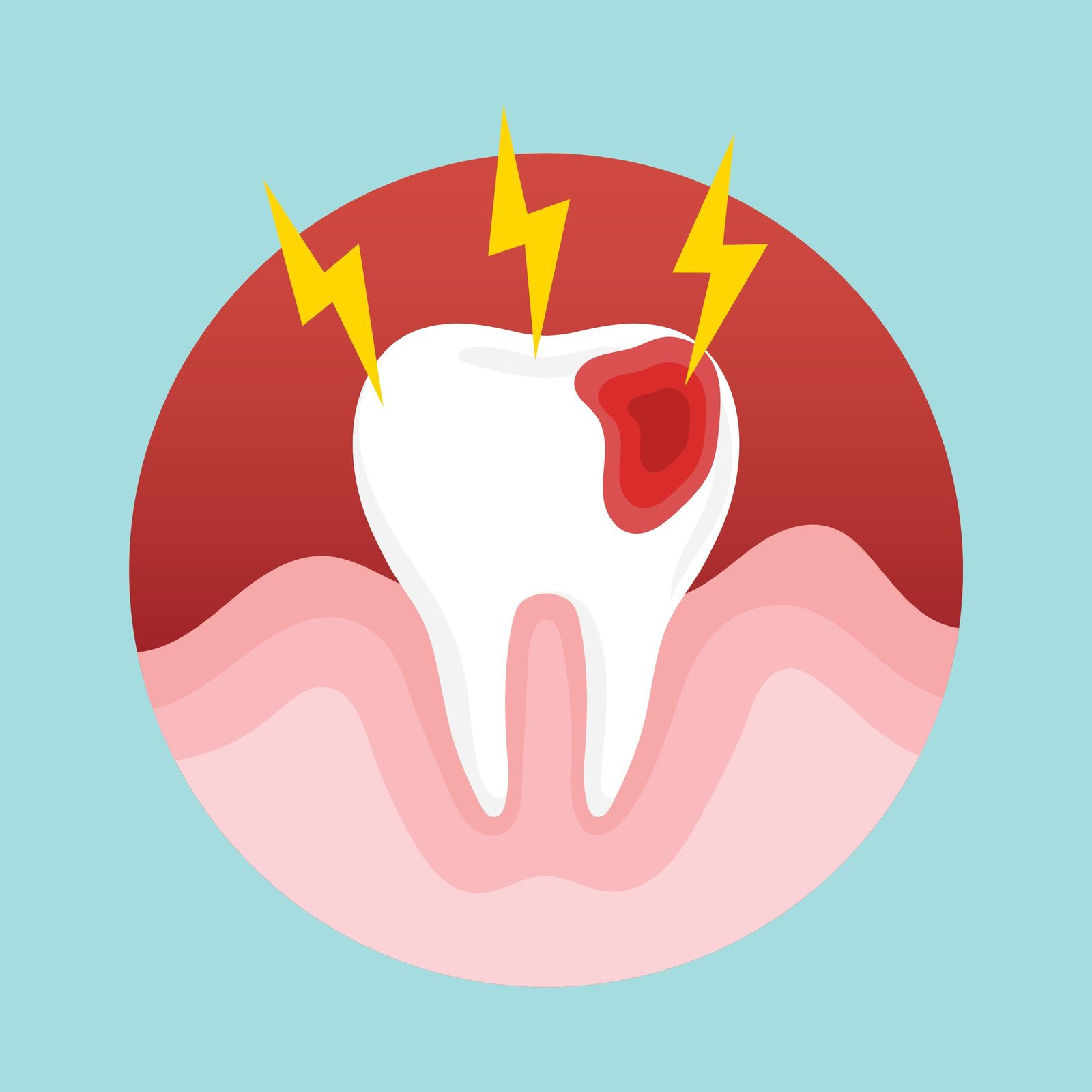 Caries dental
